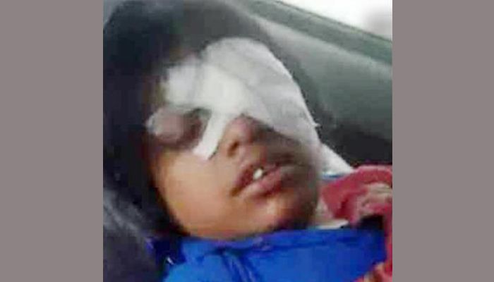 শিক্ষকের বেতে চোখ হারাতে বসেছেন শিক্ষার্থী