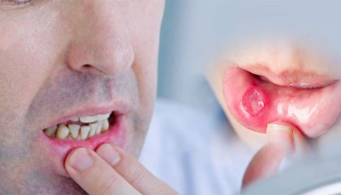 মুখের ঘা কেন হয়? এর কারণ, উপসর্গ ও করণীয়
