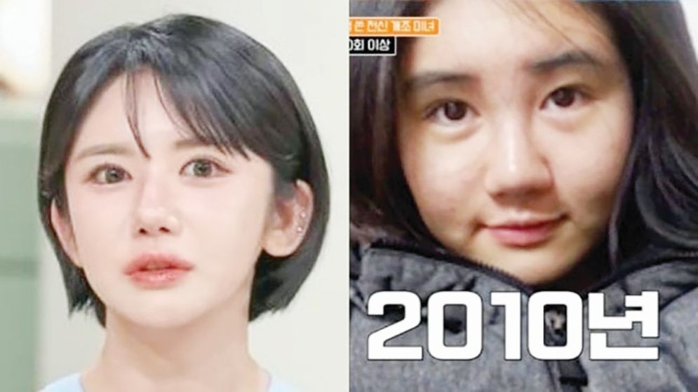 সৌন্দর্যের নেশায় কোরিয়ান নারীর ৪০০ সার্জারি!